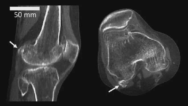 Fabela lateral en la parte posterior de una rodilla humana, perfil lateral. Crédito: Imperial College London