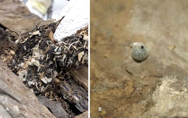 Izquierda: La extracción de partes del material extraño de la pared abdominal dorsal reveló una mezcla de fragmentos de tejido blanco, pequeñas astillas de madera y material vegetal, junto con algunos residuos de tejido amorfo de color marrón. Derecha: La esfera extraña redonda detectada en la pelvis izquierda presentaba un pequeño orificio con un borde elevado. Crédito: Andreas Nerlich