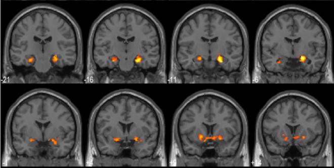Researchers used fMRI to map the brain activity of 31 participants while they solved hidden picture puzzles. The more intense their “aha! moment,” the more blood flow there was to those parts of the brain. Image credit: Becker et al.
