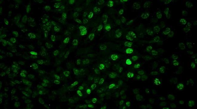 Células de glioblastoma humano expresando la proteína Foxp3 en verde luego de la irradiación. El bloqueo de esa proteína mejoró la eficacia terapéutica en estudios in vitro. Crédito de la imagen: Marianela Candolfi et al.
