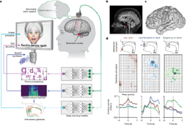 Decodificación multimodal del habla en un participa. Crédito de la imagen: Edward F. Chang et al