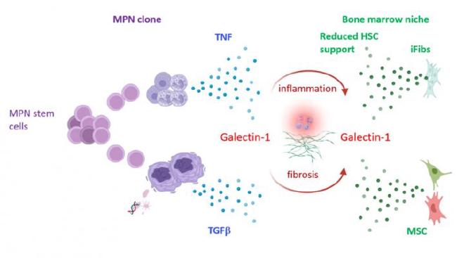 Ejemplar de biopsia de médula ósea, que muestra una expresión densa de galectina-1 en mielofibrosis (tinción marrón). Crédito: Profesor Daniel Royston, Universidad de Oxford.