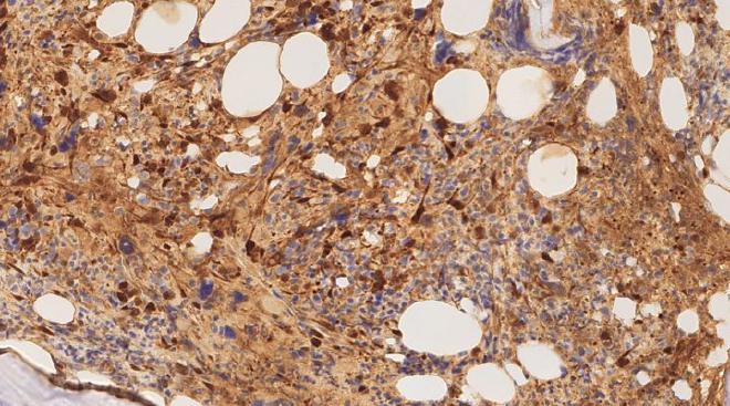 Ejemplar de biopsia de médula ósea, que muestra una expresión densa de galectina-1 en mielofibrosis (tinción marrón). Crédito: Profesor Daniel Royston, Universidad de Oxford.