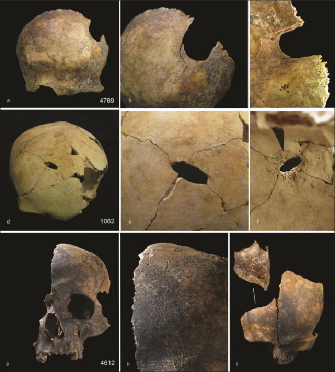 Ejemplos de traumatismo craneal. Arriba) lesión perimortem en la parte posterior izquierda del hueso frontal (a), también se pueden ver marcas de corte en el hueso frontal (b) y el bisel patinado de la superficie craneal interna es evidente alrededor de la lesión (c); medio) cráneo con una lesión perforante en el hueso frontal medio (d), una vista más cercana muestra líneas de fractura irradiadas (e) y la vista interna muestra bisel patinado (f); abajo) cráneo adulto (g), una inspección minuciosa muestra marcas de corte que recorren el hueso frontal medio (h) y una fractura perimortem por fuerza contundente en el fragmento del hueso frontal derecho contiguo (i) Imágenes de Schulting et al. Antiquity, diciembre de 2024.