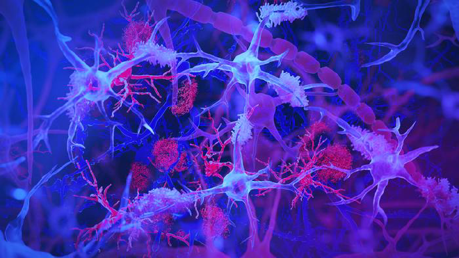 Las células inmunitarias del cerebro, o microglia (azul claro/violeta), se muestran interactuando con placas amiloides (rojo), acumulaciones de proteínas dañinas vinculadas con la enfermedad de Alzheimer. La ilustración destaca el papel de la microglia en el control de la salud cerebral y la limpieza de desechos. Ilustración de Jason Drees/Universidad Estatal de Arizona